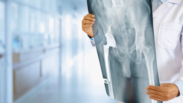 VA DISABILITY RATING FOR HIP PAIN