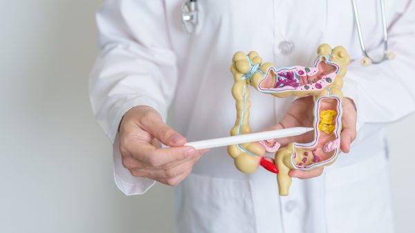 What is the Diverticulitis VA Rating