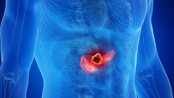 Pancreatitis VA Rating