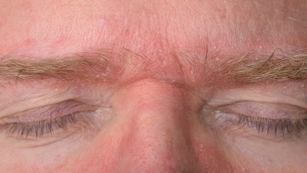 Seborrheic Dermatitis VA Rating Explained