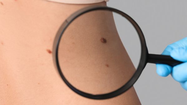 How to Get VA Disability for Skin Cancer