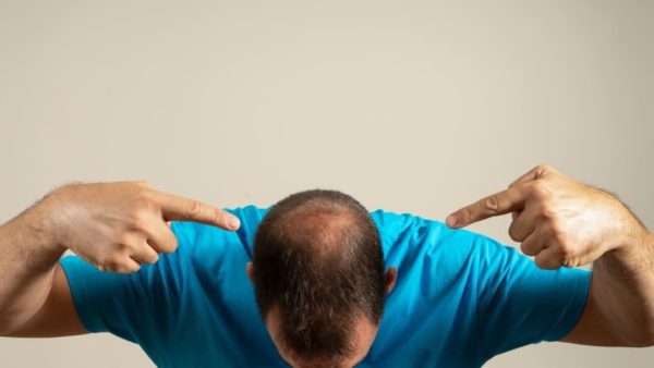 ALOPECIA VA RATING